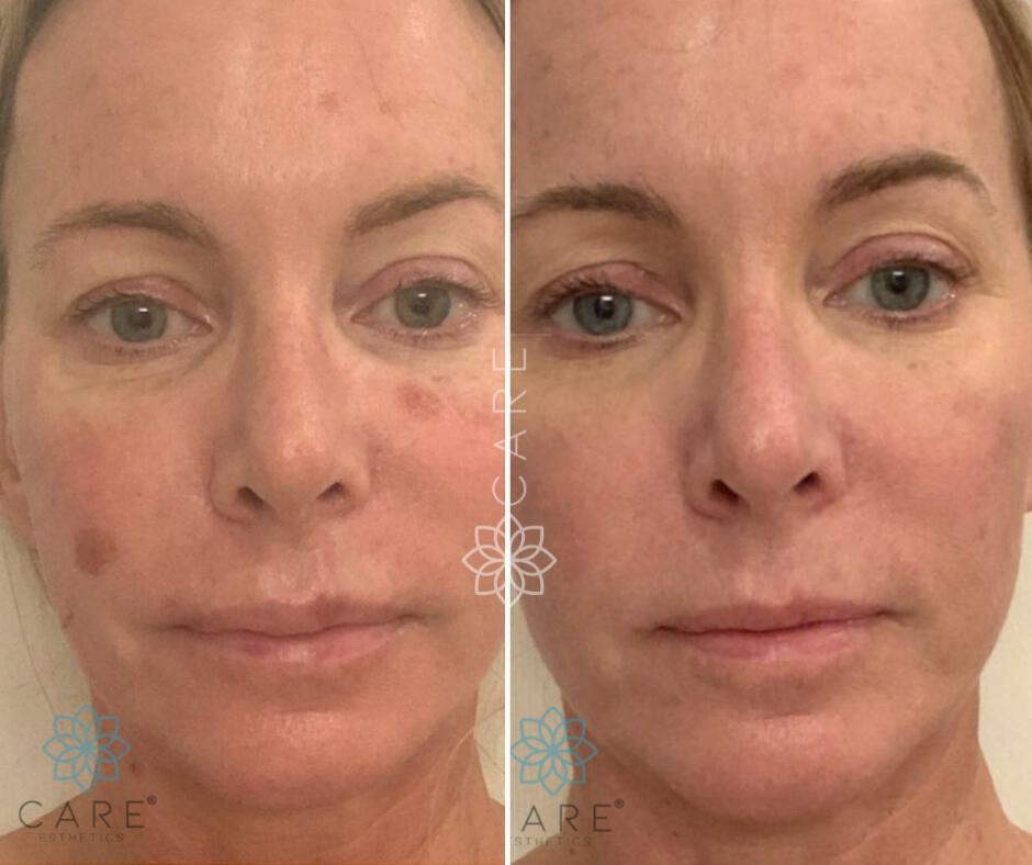 Skin Treatments Before & After Image