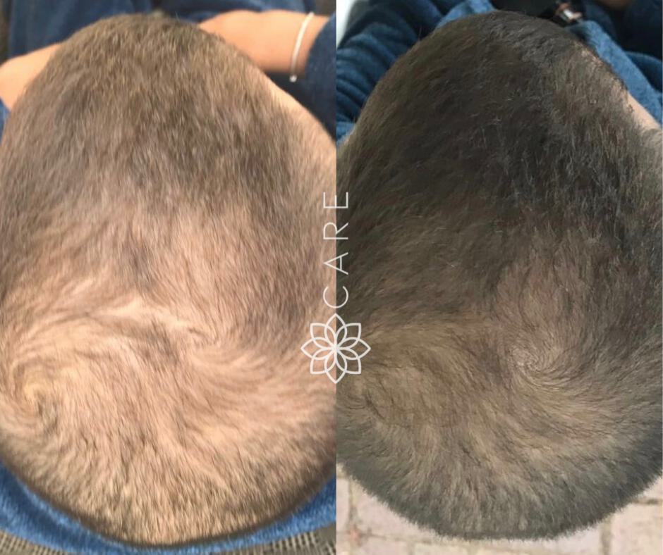 Hair Restoration (PRF) Before & After Image